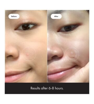 Mighty Patch Original from Hero Cosmetics – Hydrocolloid Acne Pimple Patch for Covering Zits and Blemishes, Spot Stickers for Face and Skin, Vegan-friendly and Not Tested on Animals (36 Count) - Image 4